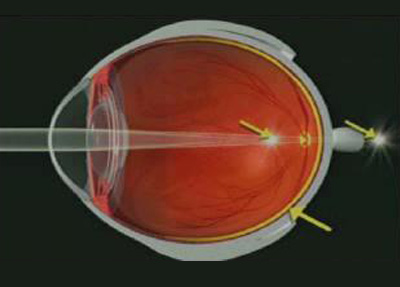 Astigmatismo 01