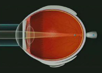 Astigmatismo 03