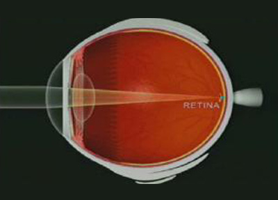 Astigmatismo 04