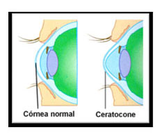 Ceratocone