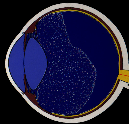 Deslocamento da retina
