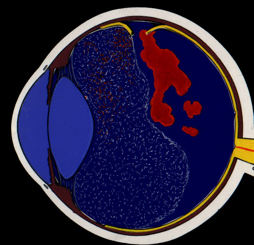 Deslocamento da retina