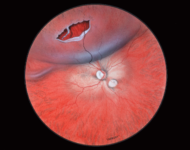 Deslocamento da retina