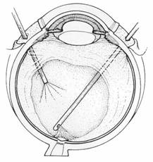 Deslocamento da retina