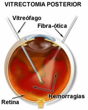 Deslocamento da retina
