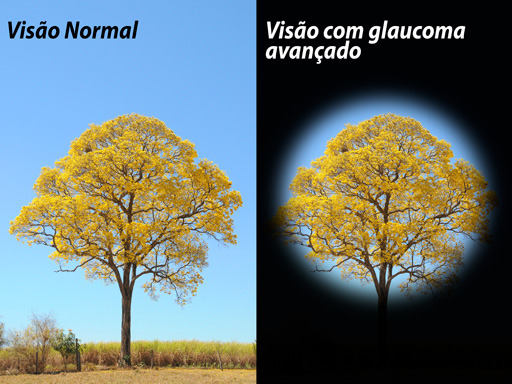 Glaucoma