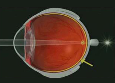 Hipermetropia 01
