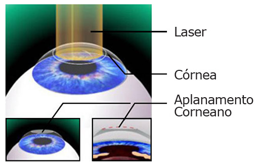 Laser de superfcie