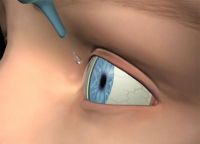 Lasik