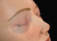  Lasik 3